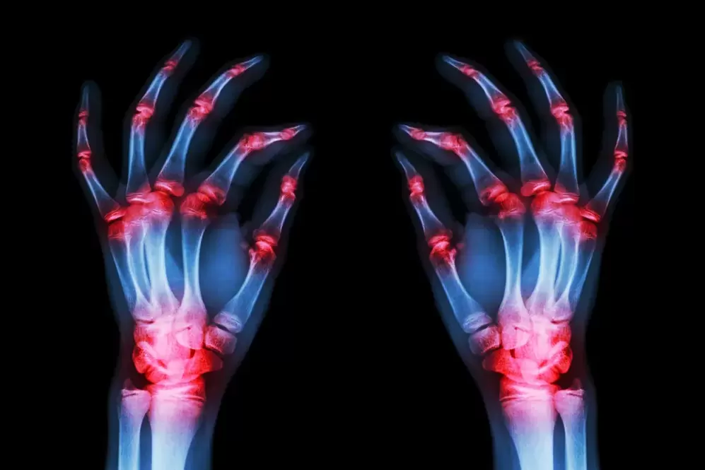artroza articulațiilor degetelor