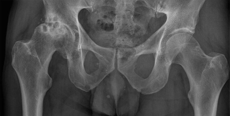Stadiul 3 artroza articulației șoldului la radiografie