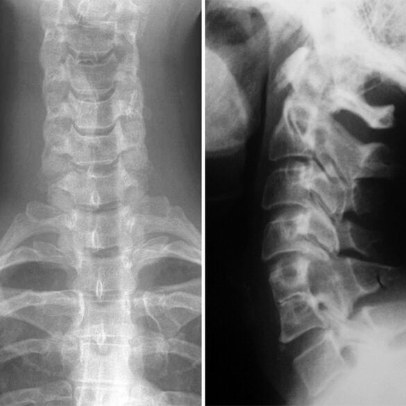 X -RAY OF THE CERVICAL
