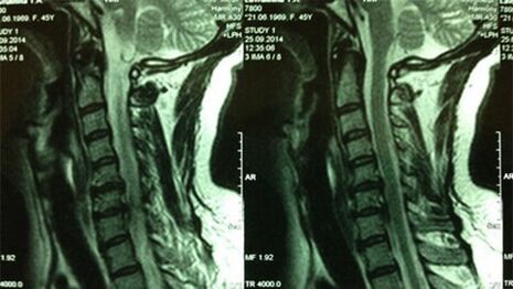 RMN al departamentului cervical