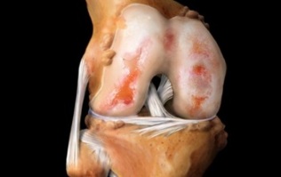 ce este artroza genunchiului