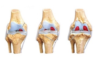 etapele de artroză a articulației genunchiului