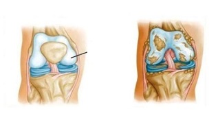 modificări patologice în artrozele genunchiului
