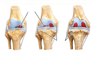 etapele artrozei genunchiului