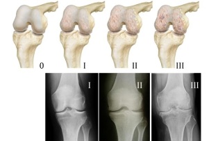 metode pentru diagnosticarea artrozei genunchiului