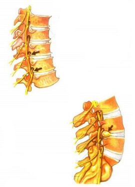 ilustrare a osteocondrozei coloanei vertebrale