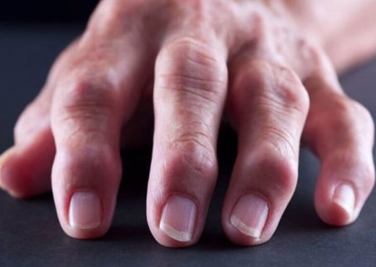 artrita reumatoidă ca o cauză a durerii în articulațiile degetelor