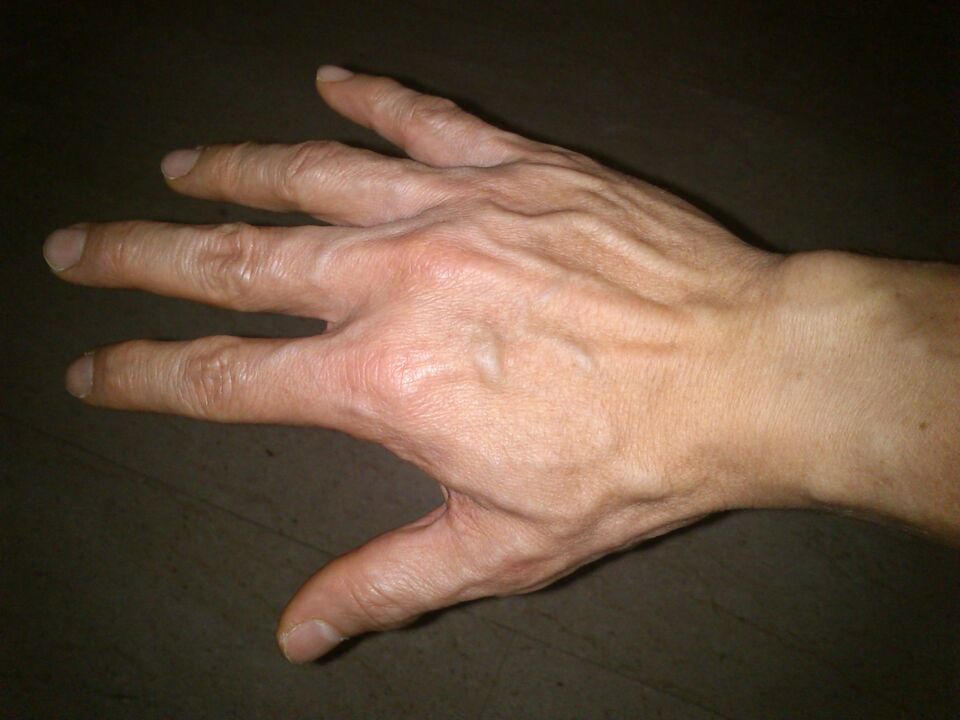 deformarea oaselor și durerea în articulațiile degetelor