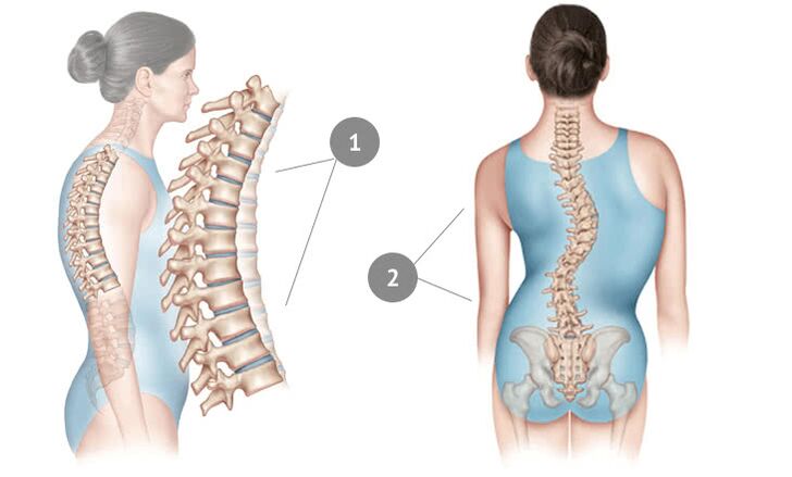 curbura coloanei vertebrale ca cauza a osteocondrozei toracice