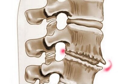 afectarea vertebrelor cu osteocondroză toracică