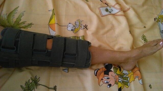 imobilizarea articulației genunchiului pentru durere